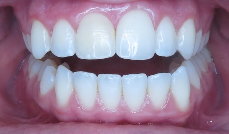 alta-smiles_c3-hidden-orthodontics_Case 2 After