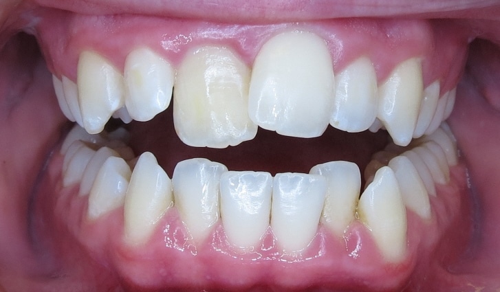 alta-smiles_c3-hidden-orthodontics_Case 2 Before