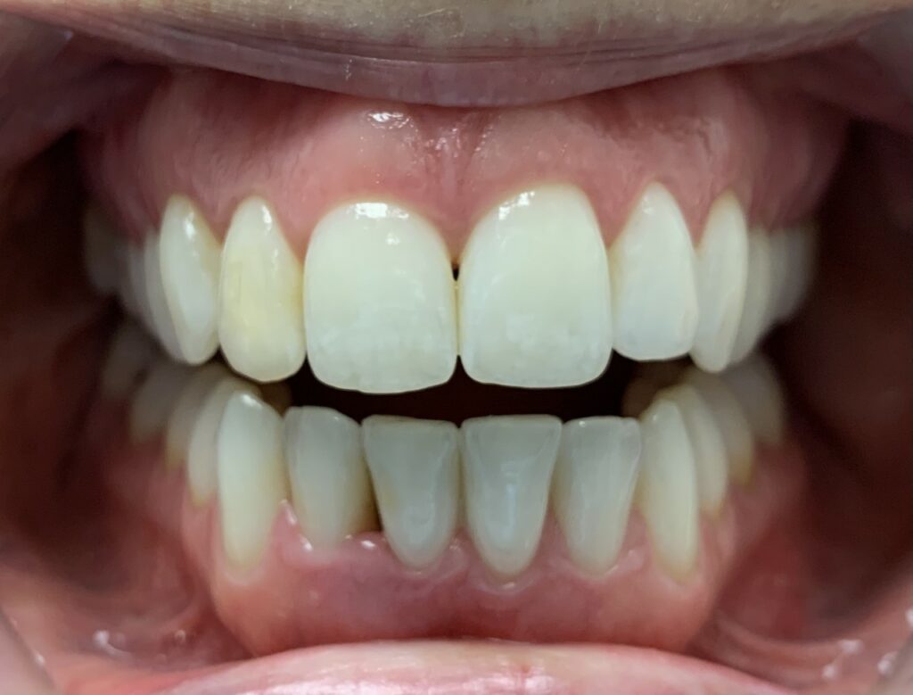 alta-smiles_c3-hidden-orthodontics_Case 3 After