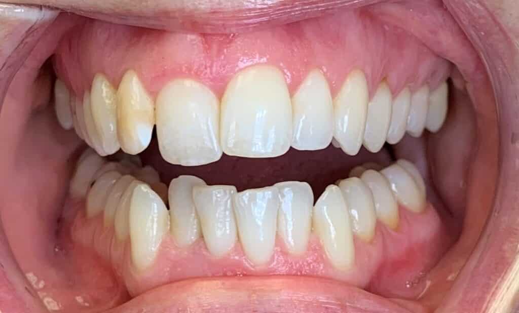 alta-smiles_c3-hidden-orthodontics_Case 3 Before