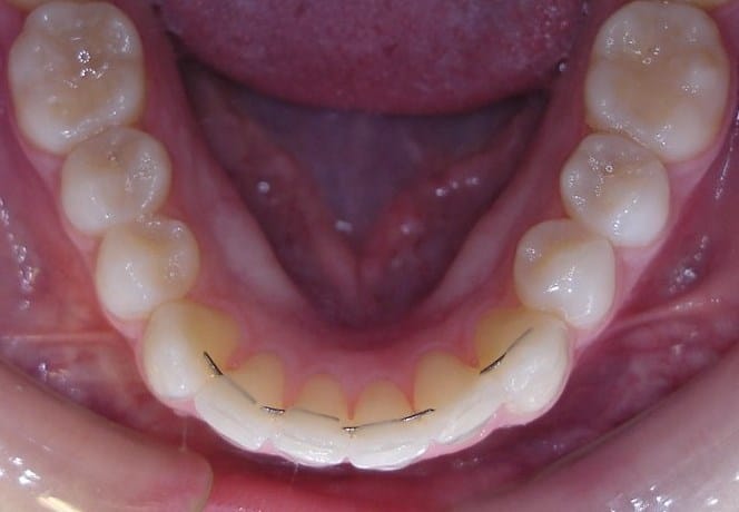 alta-smiles_c3-hidden-orthodontics_Case 6 After
