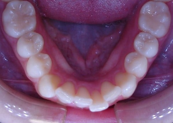 alta-smiles_c3-hidden-orthodontics_Case 6 Before