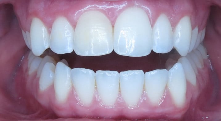C5 Hidden Orthodontics™ After