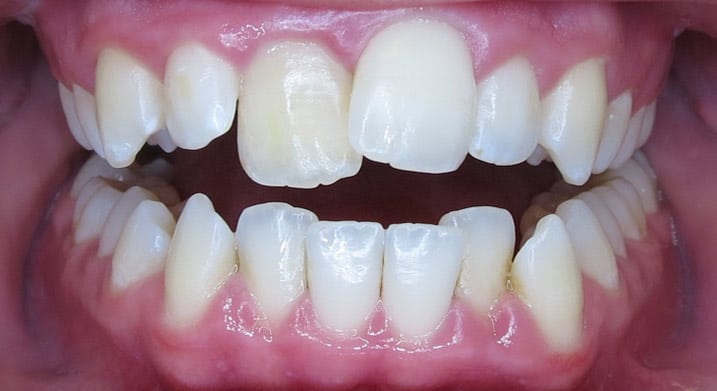 C5 Hidden Orthodontics™ Before