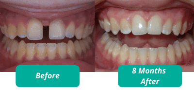Invisible braces C3 Hidden Orthodontics Before & After