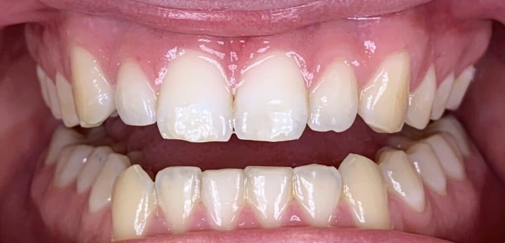 C5 Hidden orthodontics lingual braces After