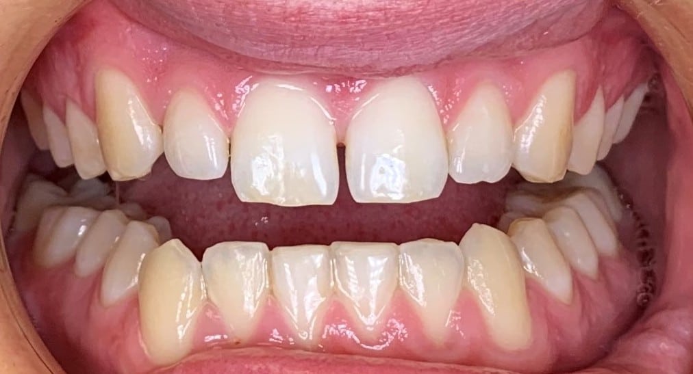 C5 Hidden Orthodontics Lingual Braces Before
